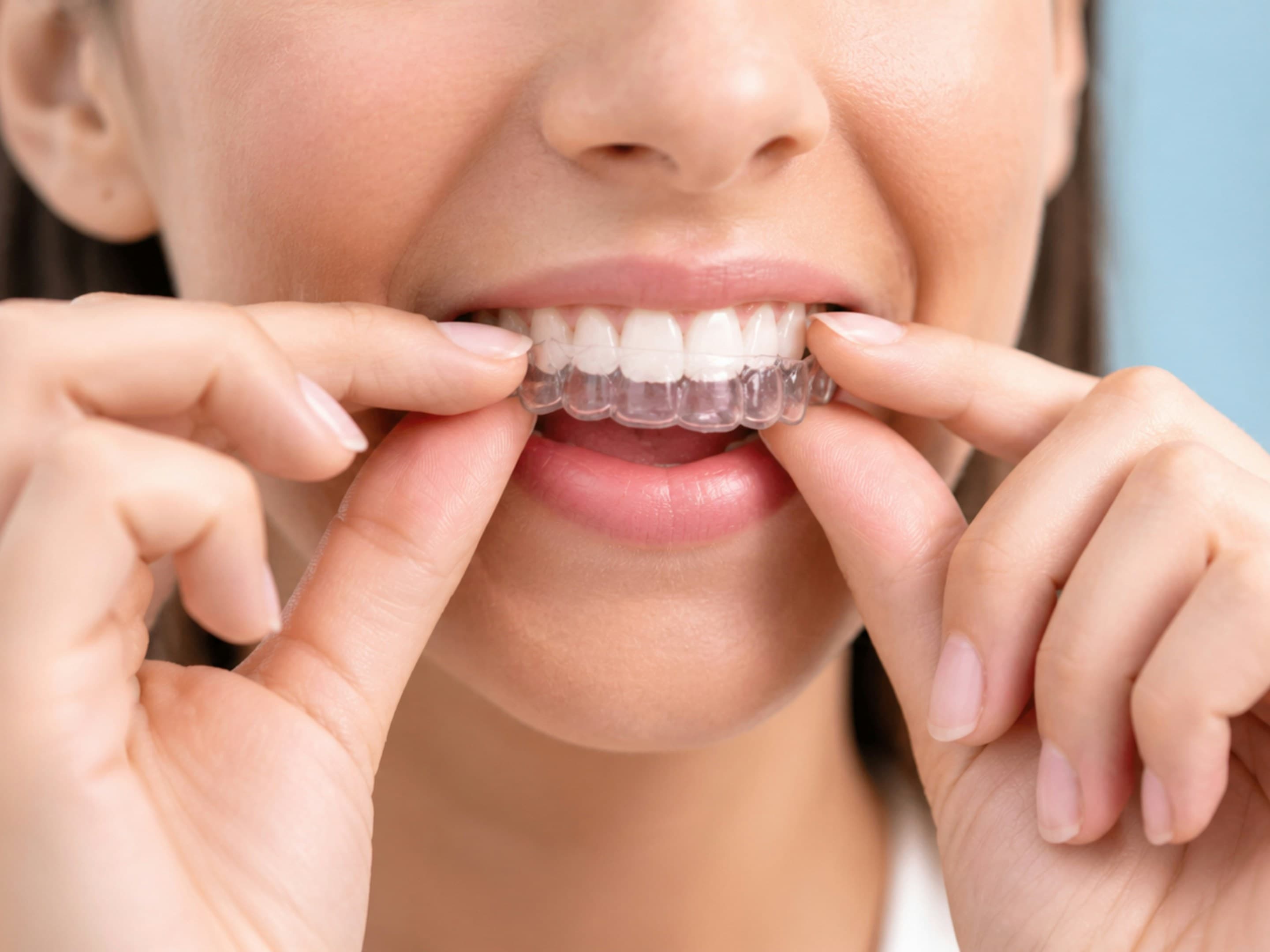 Braces Aren't Just for Kids: Straightening as an Adult